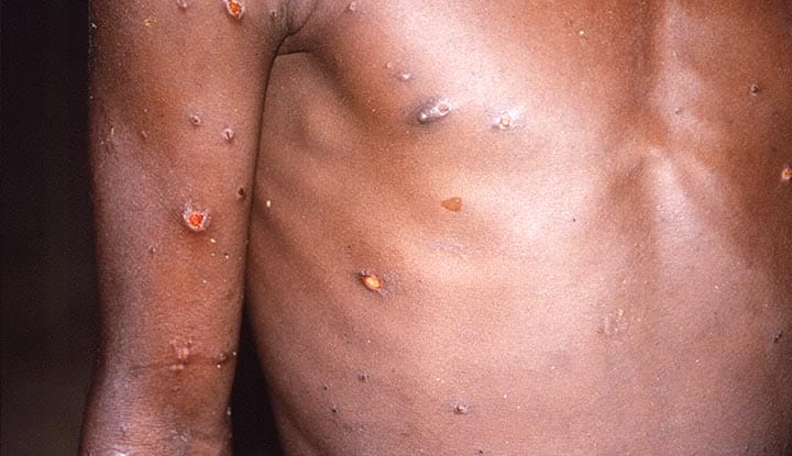 monkeypox symptoms